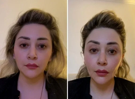 Antes e depois — rosto mais descansado em 2 semanas