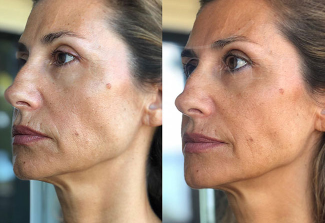 Antes e depois — pele mais firme e iluminada